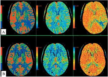 МР-перфузия