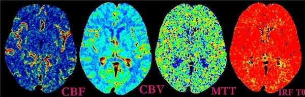 КТ-перфузия 