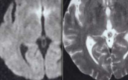 ОНМК через 2 недели.