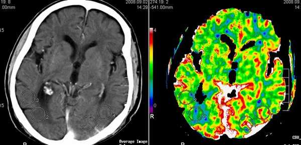 Перфузионная КТ мозга