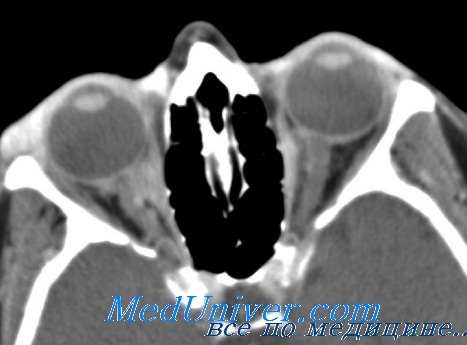 эндокринная офтальмопатия