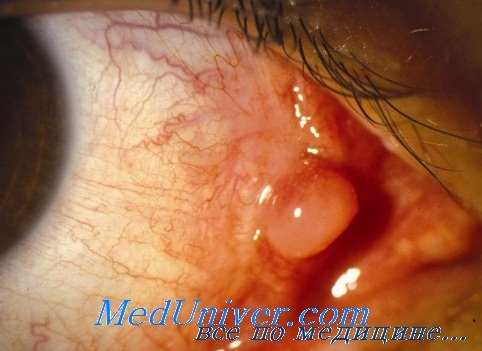 лучевая терапия рака глаза