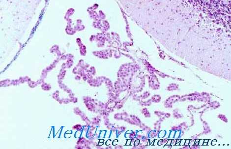 лучевая терапия опухоли сосудистого сплетения мозга