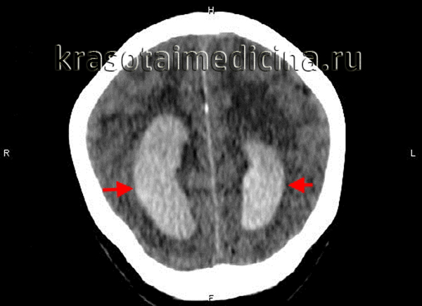 КТ головного мозга. В задних рогах обоих желудочков – гиперденсное содержимое (кровь)