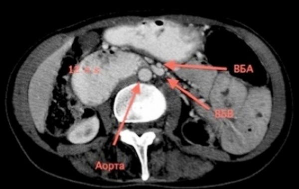 КТ органов брюшной полости. Артериомезентериальная компрессия.