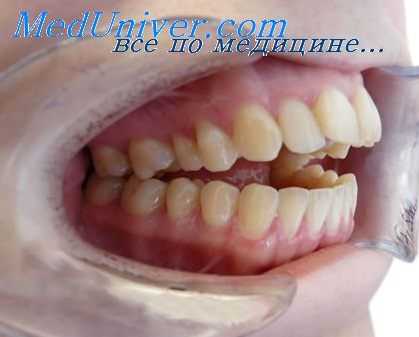 изменения пародонта при перемещении зубов