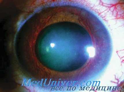 влияние гризина на глаза