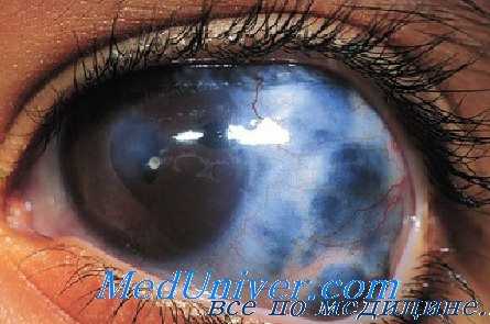 фурфуроловая глаукома