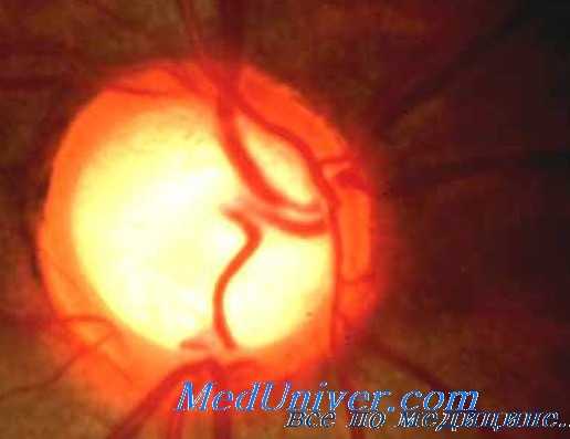 ангиопатия сетчатки под влиянием антибиотиков