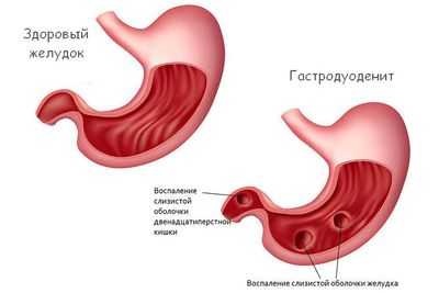 Желудок здоровый и с гастродуоденальной патологией