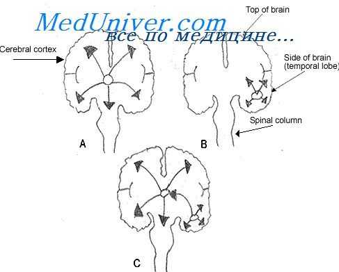 прогноз эпилепсии