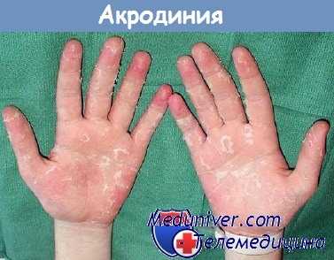 Акродиния