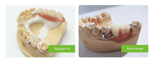 бюгельные и квадротти протезы