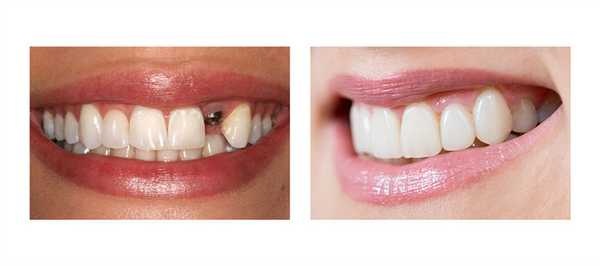 Фото до и после протезирования без опбточки
