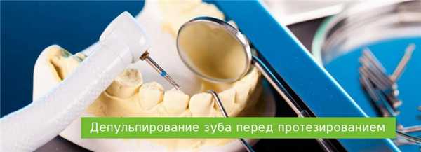 Нужно ли депульпирование зуба перед протезированием?
