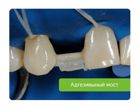 адгезивный мост