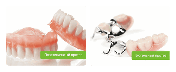 бюгельный и пластинчатый протез