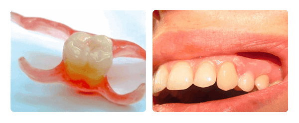 протез бабочка.png