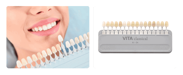 подбор цвета коронки на зуб