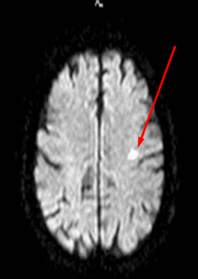 Лакунарный инфаркт головного мозга на МРТ