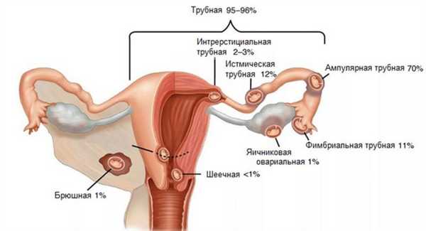 признаки внематочной беременности