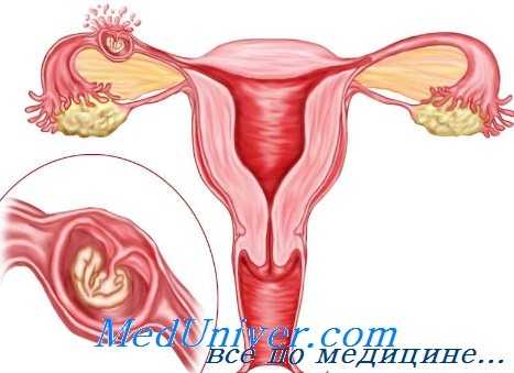 внематочная беременность