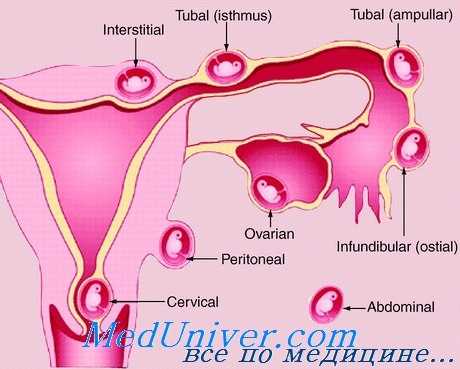 эктопическая беременность