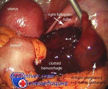 внематочная беременность
