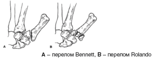 Переломы основания 1 пястной кости