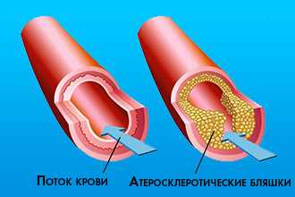 Профилактика ВКС и скрининг групп риска