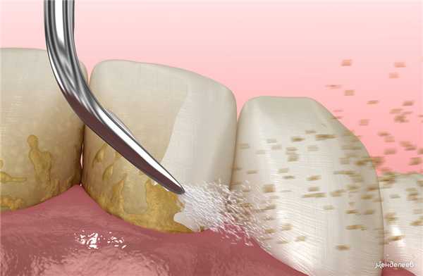 удаление отложений на зубах при помощи ультразвуковой чистки