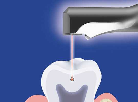 Эндоотбеливание