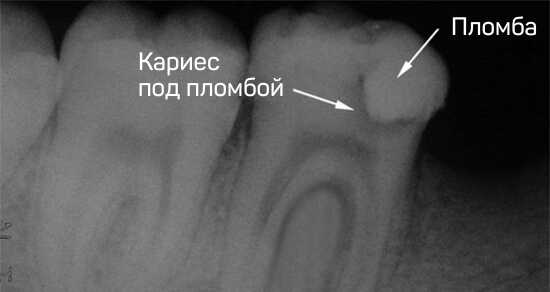Скрытый или вторичный кариес