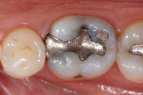 Амальгамные пломбы