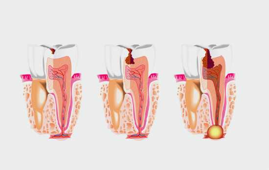 Периапикальная гранулема