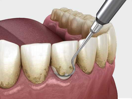 Профессиональная комплексная чистка и отбеливание