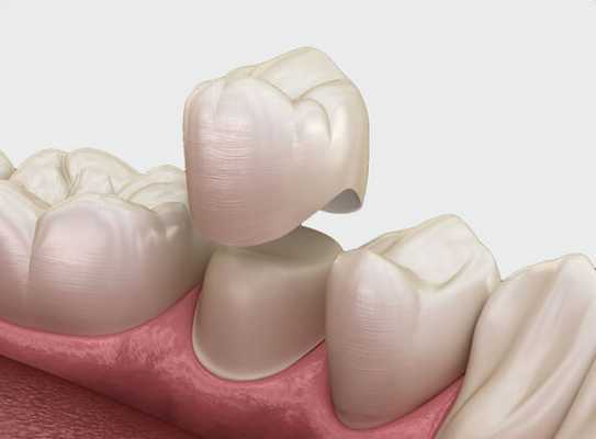 Протезирование коронками