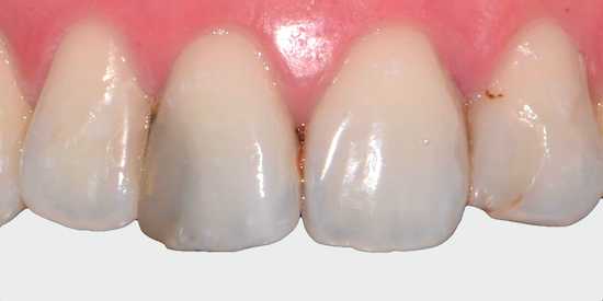 Использование некачественных материалов