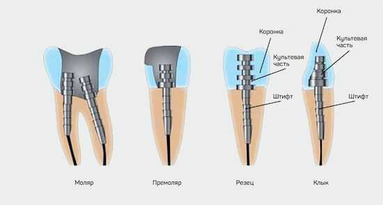 Внутриканальные серебряные штифты