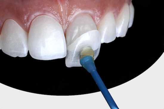 Установка виниров