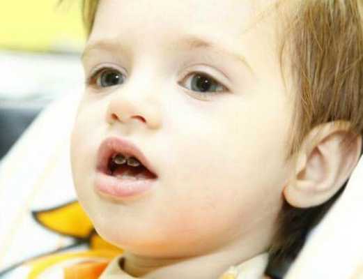 Потемнение зубного ряда у детей