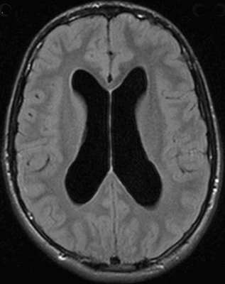 Гидроцефалия на МРТ