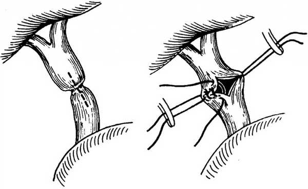 Билиодигестивный анастомоз