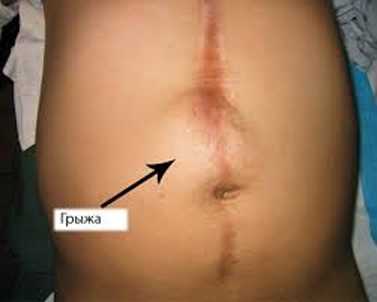 posleoperatcionnaia_gryzha_briushnoi_polosti