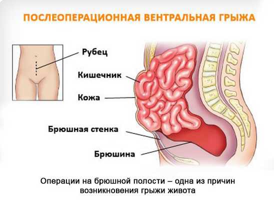 Что такое послеоперационная грыжа