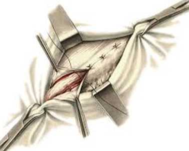 operatciia_dlia_ustraneniia_ventralnoi_gryzhi