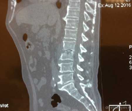 компьютерная томография до операции
