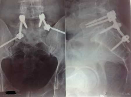 транспедикулярная фиксация позвоночника