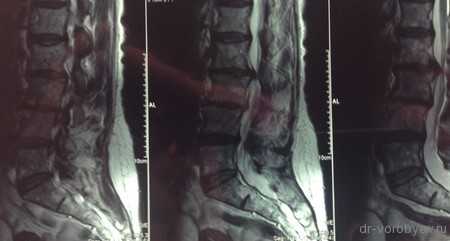 мрт до операции