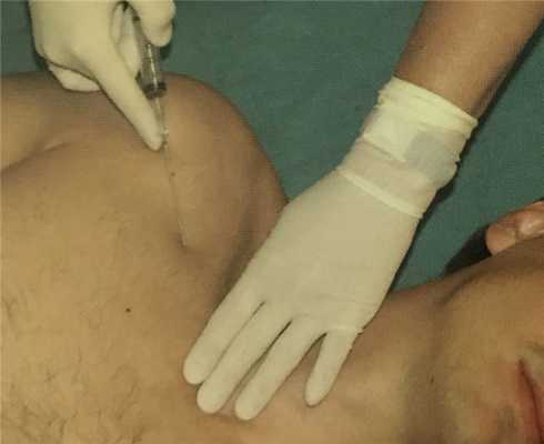 подключичный доступ при катетеризации